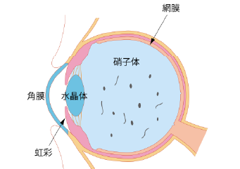 飛蚊症